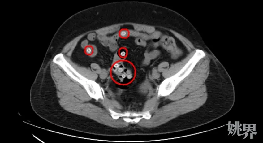宁波女子痛不欲生！肠道里全是密密麻麻的……医生提醒