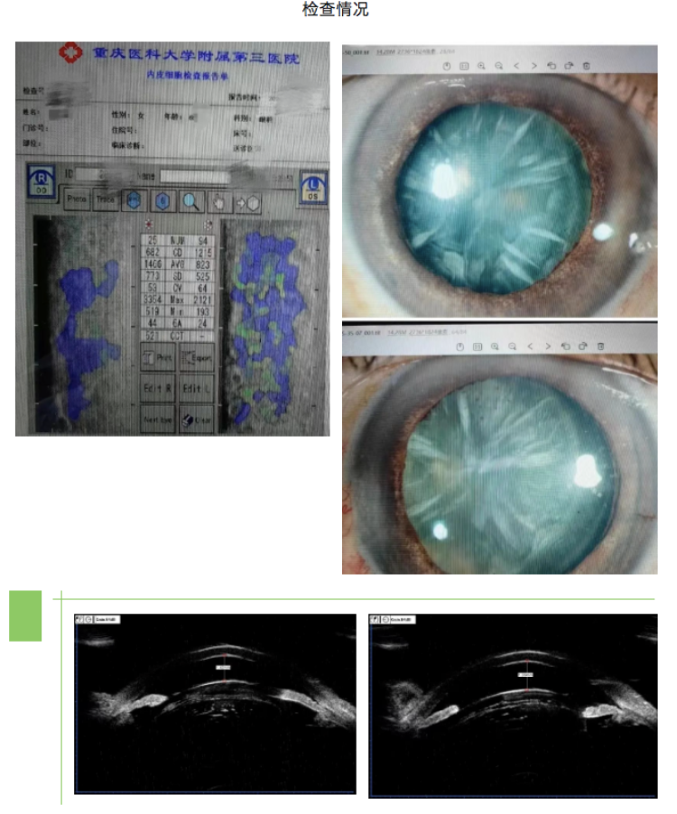 重医三院·医疗动态｜重医大附三院眼科完成一例双眼晶体脱位复杂高难度手术