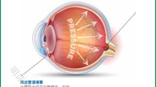 兰州爱尔眼科韦萍院长丨青光眼有哪些不同的类型？