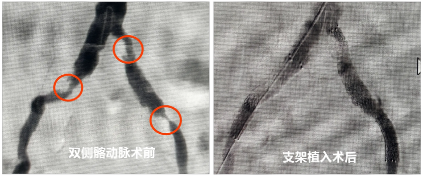 轻要腿，重要命！哪类人易患“腿梗”？听听心外科博士怎么说！