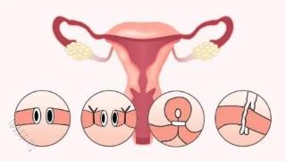 女性在做输卵管复通手术前需要注意些什么？