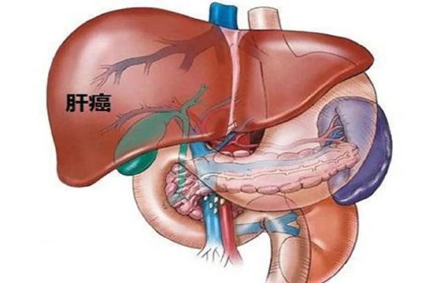 为什么肝癌一发现就是晚期？因为这些早期信号你很容易忽视