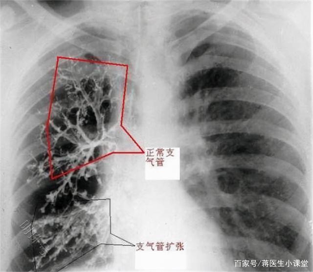 戒烟能降低患癌几率是真的吗？一文揭晓答案