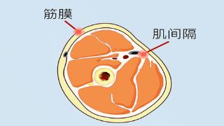 筋膜提升是不是线雕