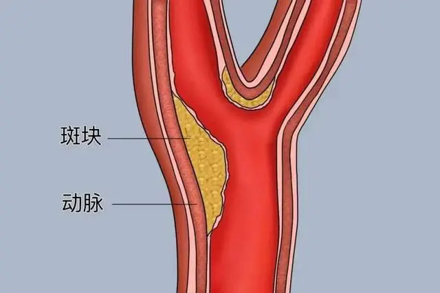 不可忽视的“颈部隐患”：颈动脉斑块！斑块如何形成？如何检测？