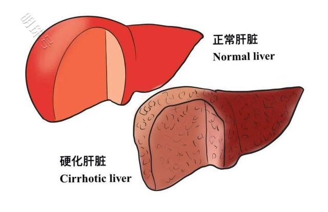 肝开始变硬，头部会有5个异常，看看你有吗？