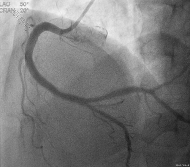 冠状动脉造影术有什么作用？检查前后有哪些注意事项？一文解答