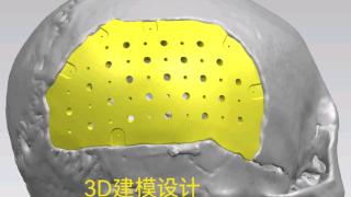 夏小雨医生团队成功运用3D打印PEEK材料：助力颅骨修补精准化