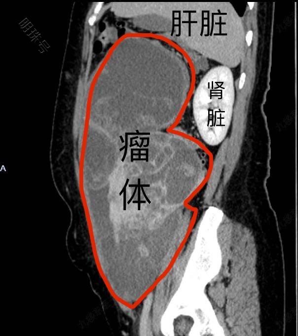 罕见！女子肚子变大，竟是藏了16斤的子宫肌瘤