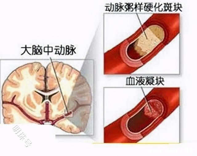 血压正常还会发生并发症，怎么办？一文参考下方法