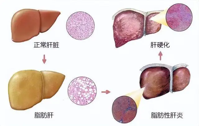 经常喝酸奶，可以改善脂肪肝？医生：做好4件事，肝脏悄悄好