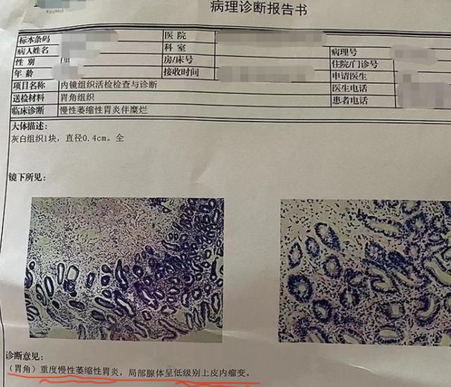 萎缩性胃炎“低级别瘤变”会变癌吗？协和医院46年中医给你答案