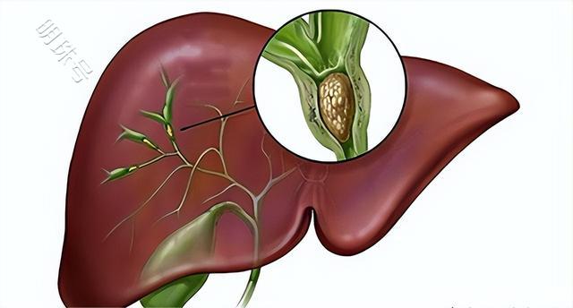 胆管癌的三个部位出现“警报”，医生表示要尽快检查