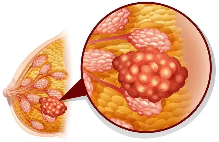 乳腺纤维腺瘤是癌症？医生：别慌张，坚持做好这5件事可缓解病情