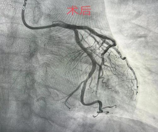 急性心肌梗死，他用“估至关重要”自救