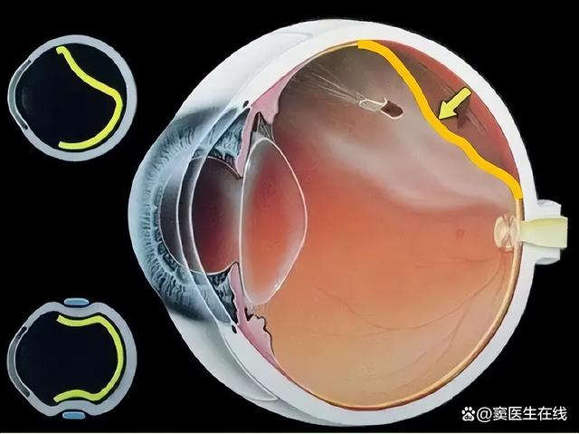 糖尿病患者：身上若有这3种表现，需警惕并发症