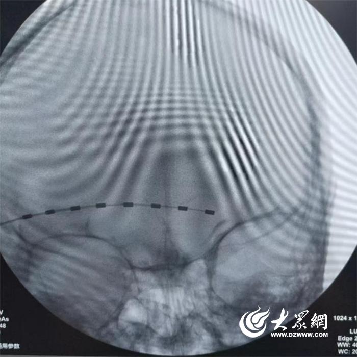 东营市第五人民医院开展“脊髓电刺激植入术”治疗带状疱疹顽固性疼痛