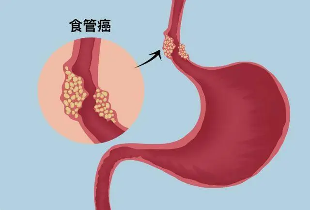 以为是慢性咽炎，去医院却查出食管癌？医生：5点区别要了解