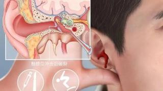 颅内感染、脑脊液从耳朵流出！一岁半娃鼓膜穿孔竟是因为……