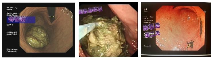 警惕胃石症！泰安市肿瘤防治院专家提醒：山楂虽美味，吃错反伤身