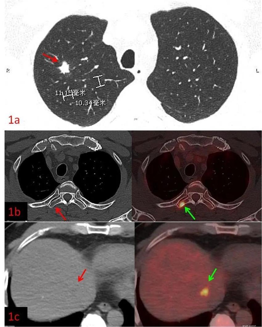 健康科普 | 发现肺癌，为什么要做PET/CT