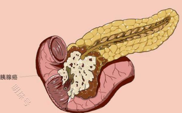 什么是胰腺？为何被称为“生命线”？科普下涨知识