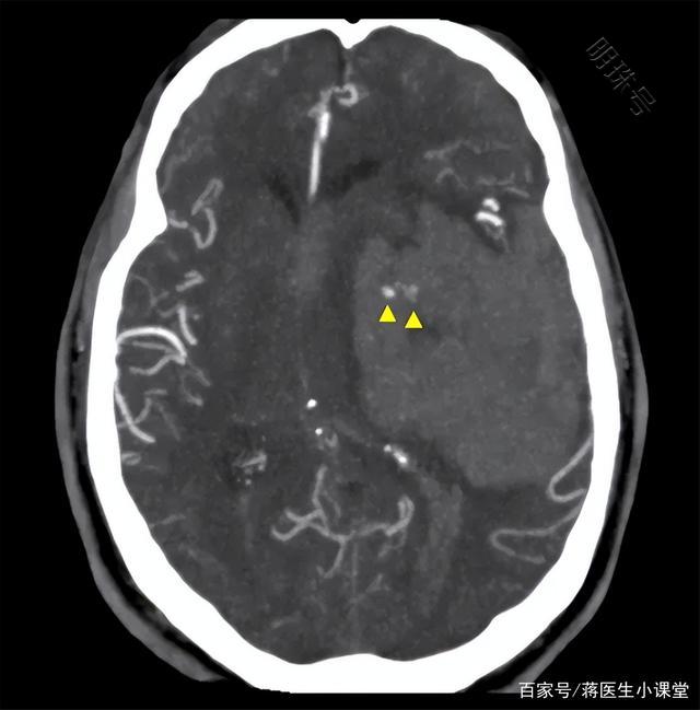 什么是高血压？高血压会导致脑出血吗？一文揭晓答案