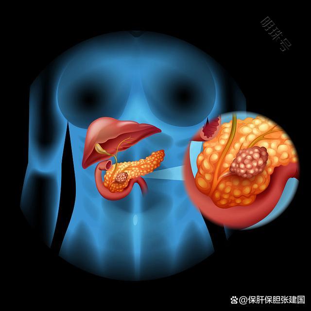 胆囊癌的发病率高吗？科普小知识