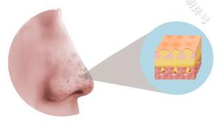 鼻子两侧，为何能挤出很多白色条状物？一文了解清楚
