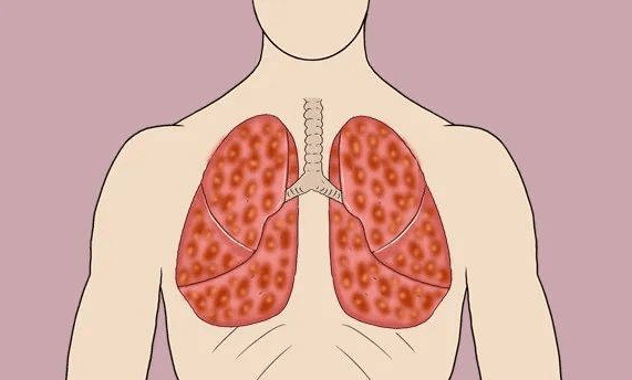 身体有癌，腰或先知，2种腰部异常病症，警觉癌症来袭