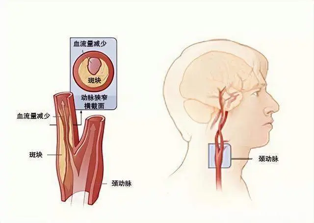 不可忽视的“颈部隐患”：颈动脉斑块！斑块如何形成？如何检测？