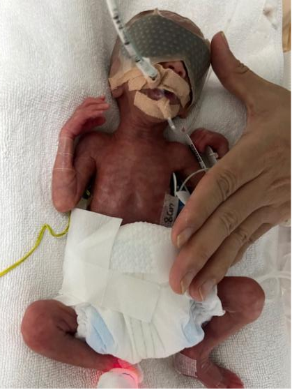 NICU抢救治疗“早到天使”，出生体重仅1050克、970克的27周双胞胎早产儿重获新生