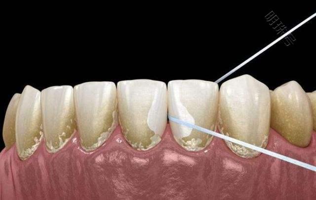 牙结石可以直接用手“抠掉”吗？牙科医生为您科普