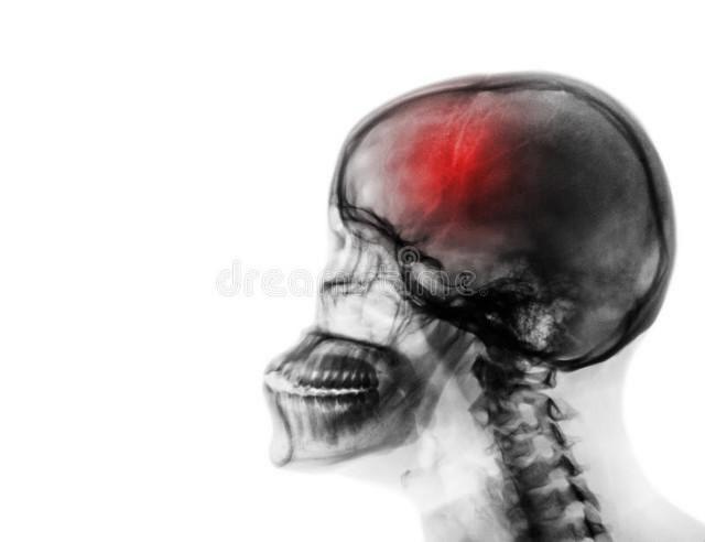 脑供血不足这个看似遥远的医学术语，正悄悄影响着许多人的生活