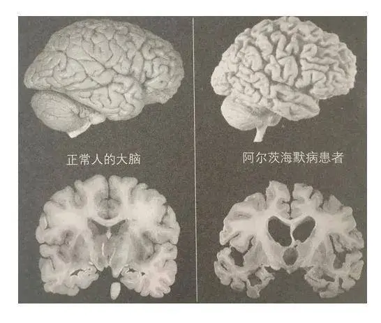 如何预防认知障碍？ 7个方法助你保护好大脑，延缓衰老