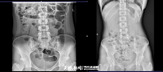 三个月瘦10斤！贵医附院成功诊断治疗一例罕见“卟啉病”