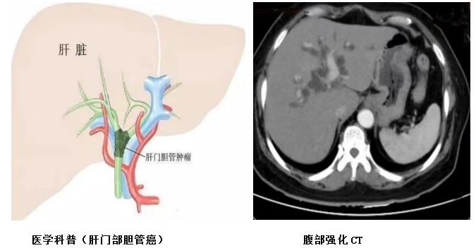 高龄胆管癌患者，也有微创手术治疗机会