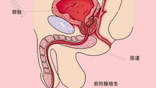 男性前列腺增生，到底什么原因导致的？一文分析下