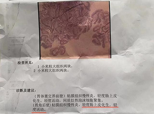 萎缩性胃炎“低级别瘤变”会变癌吗？协和医院46年中医给你答案