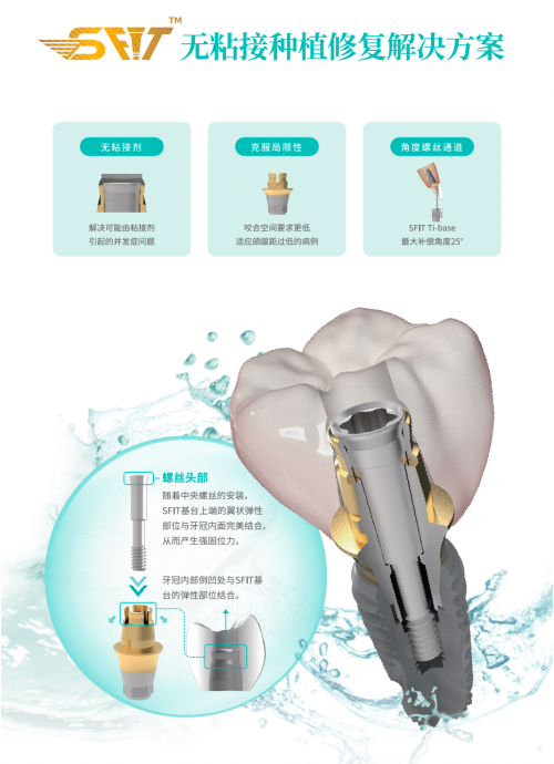 柯威尔种植体，高性价比品牌引领口腔修复新时代