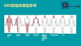 青年白领突发腰痛腿麻面瘫 西安市红会医院紧急施治