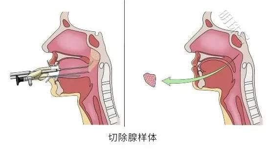 郑州民生耳鼻喉医院：腺样体肥大的危害、手术指征及预防方法