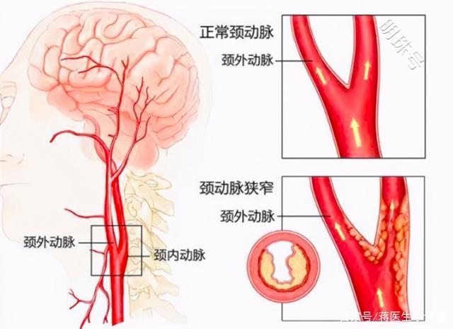 颈动脉狭窄导致70%患者偏瘫中风，支架还有意义吗？了解下