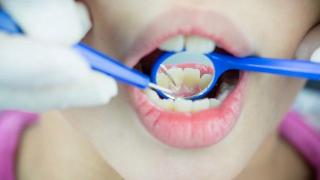 深龋不治疗，可能会导致牙齿出现明显的疼痛