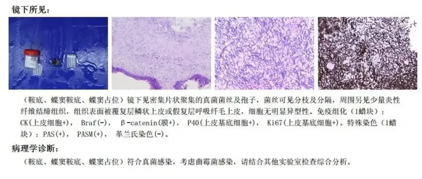 是有多潮湿？阿姨眼睛疼了大半年竟是脑袋“发霉”了……