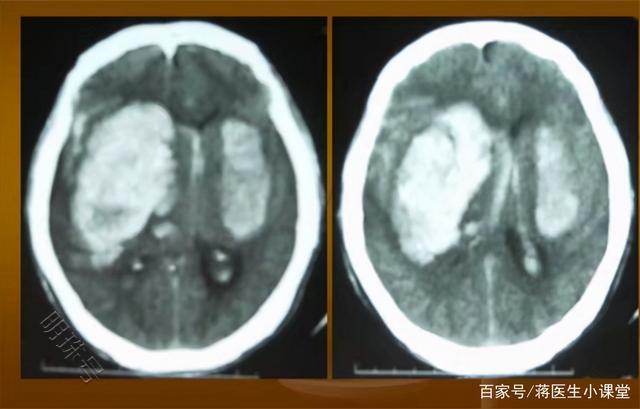 擅自把氨氯地平换成硝苯地平，吃出脑出血，赶紧看看吧