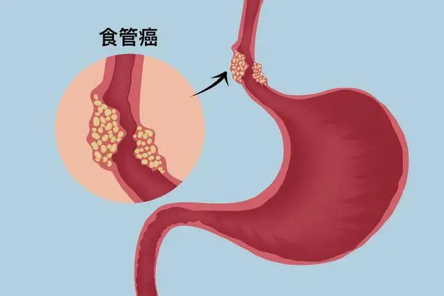 以为是慢性咽炎，去医院却查出食管癌？医生：5点区别要了解