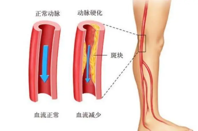 夜间睡觉时突然腿抽筋，就是缺钙？错！还有这2个原因，注意一下