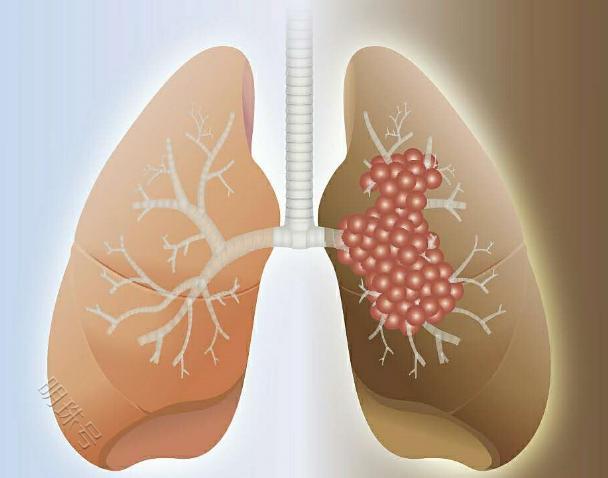 为啥肺癌一发现就是晚期？3件事可能被忽略了