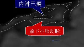 台湾耳鸣眩晕权威警示:「内淋巴囊血管压迫症」让医师也中招